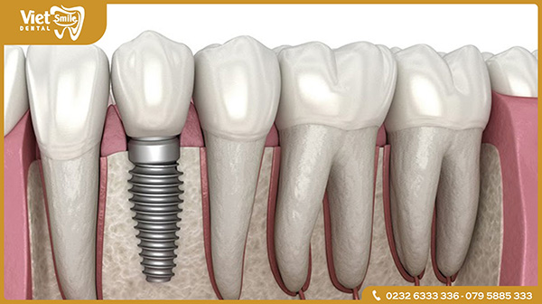 Trồng răng Implant là gì?