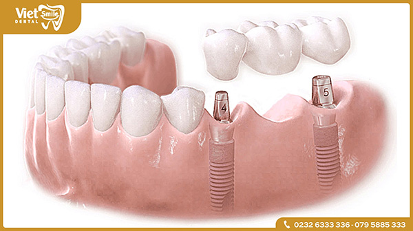 Số lượng trụ Implant