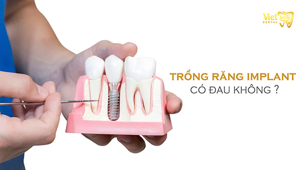 Trồng răng Implant có đau không? Các yếu tố ảnh hưởng đến mức độ đau nhức sau khi trồng răng Implant