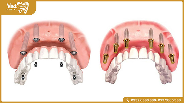 Trồng răng Implant có mấy loại?