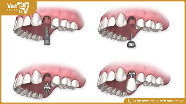 Ưu điểm của phương pháp trồng răng Implant phục hình tức thì