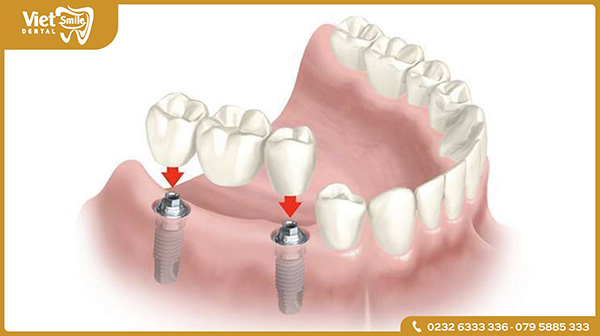 Phương pháp cầu răng sứ Implant