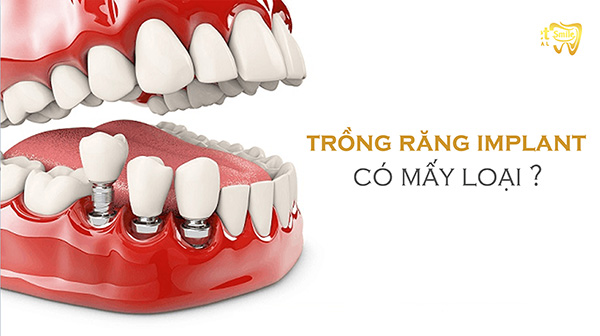 Trồng răng Implant có mấy loại? Đâu là phương pháp trồng răng hiệu quả nhất?