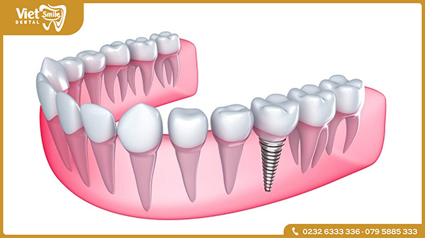 Cấy ghép Implant được thực hiện như thế nào?