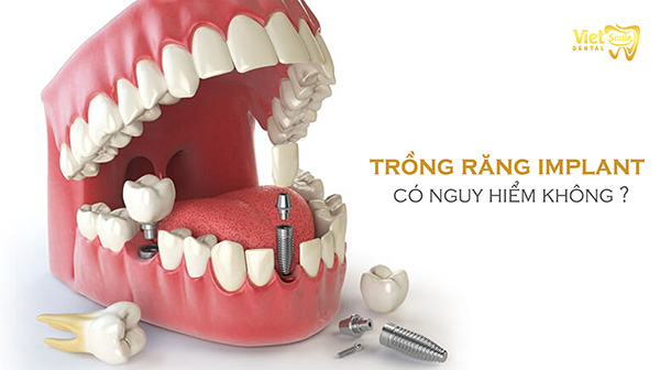 Trồng răng Implant có nguy hiểm không? 4 biến chứng nguy hiểm nếu trồng răng Implant sai cách