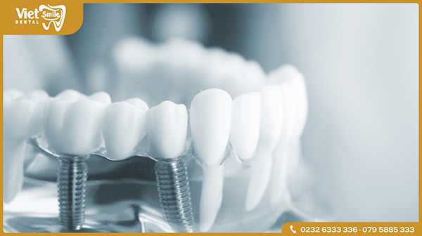 Trồng răng Implant là gì?