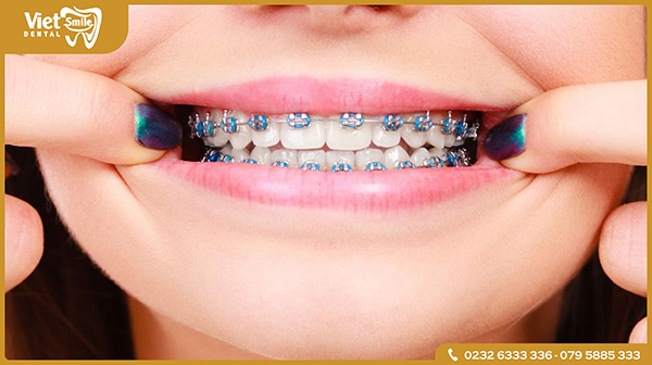 Niềng răng trước khi trồng răng Implant