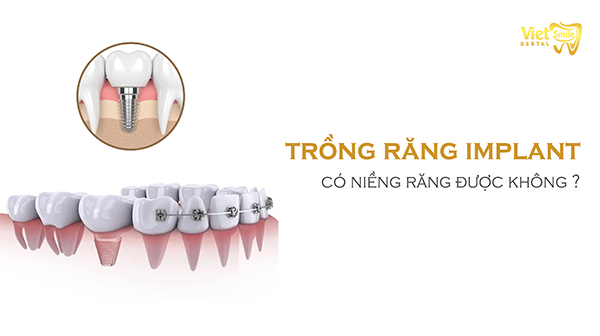 Trồng răng Implant có niềng răng được không? Cách chăm sóc răng Implant sau khi niềng đúng cách