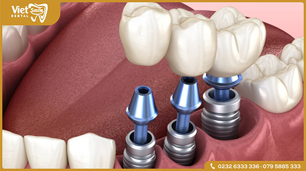 Trồng răng Implant dùng được bao lâu?