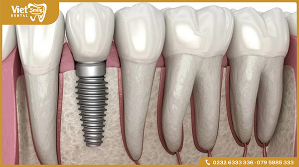 Trồng răng Implant mất bao lâu?