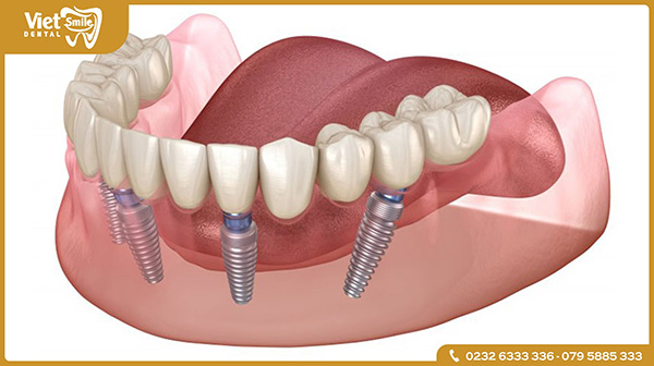 Trồng răng Implant toàn hàm