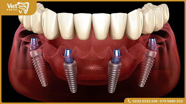 Trồng răng Implant nguyên hàm thực hiện như thế nào?