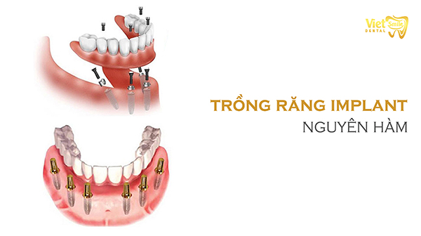 Trồng răng Implant nguyên hàm – Giải pháp tốt nhất cho mất răng toàn hàm