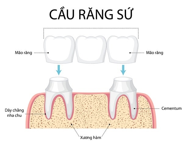 Trồng răng sứ bắc cầu có tốt không?