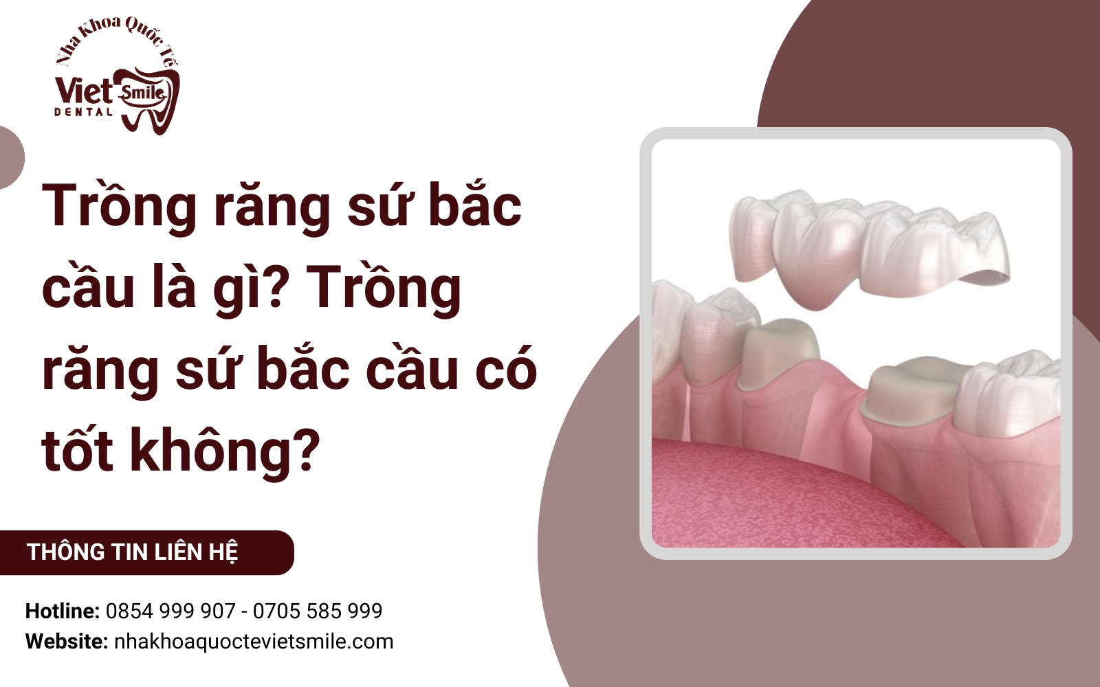 Trồng răng sứ bắc cầu là gì? Trồng răng sứ bắc cầu có tốt không?