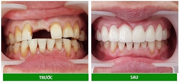 Lợi ích của kỹ thuật cầu răng sứ