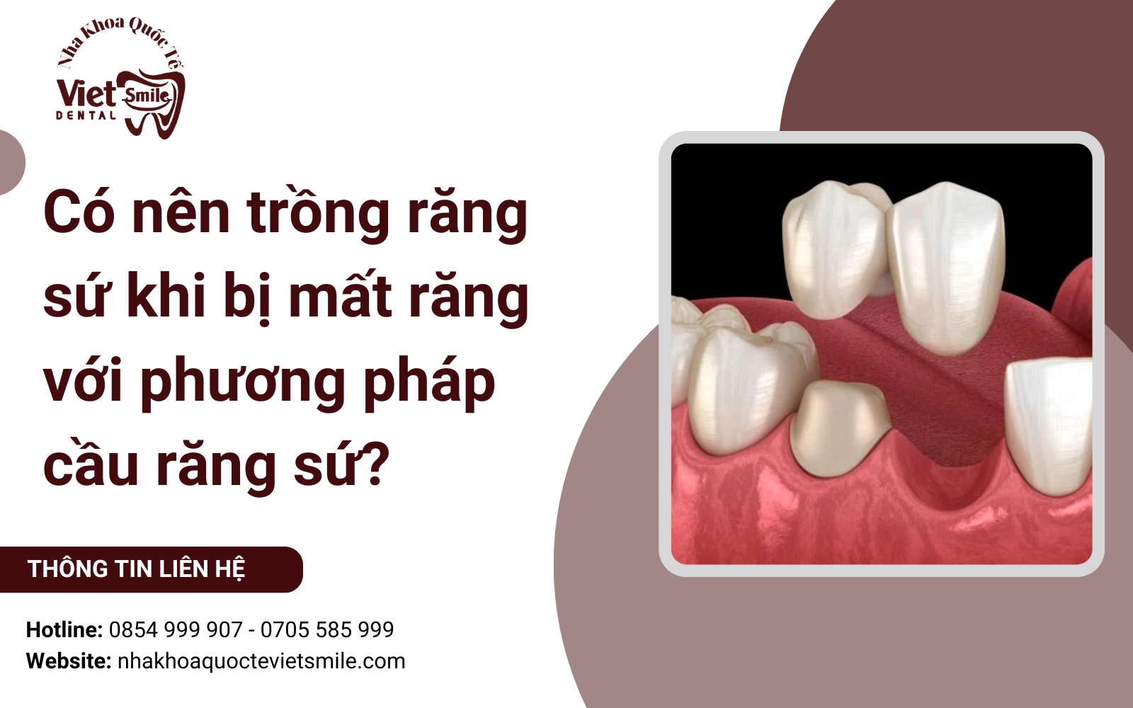 Có nên trồng răng sứ khi bị mất răng với phương pháp cầu răng sứ?