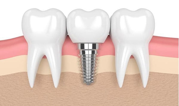 Trồng răng sứ không có chân răng từ phương pháp cấy ghép Implant