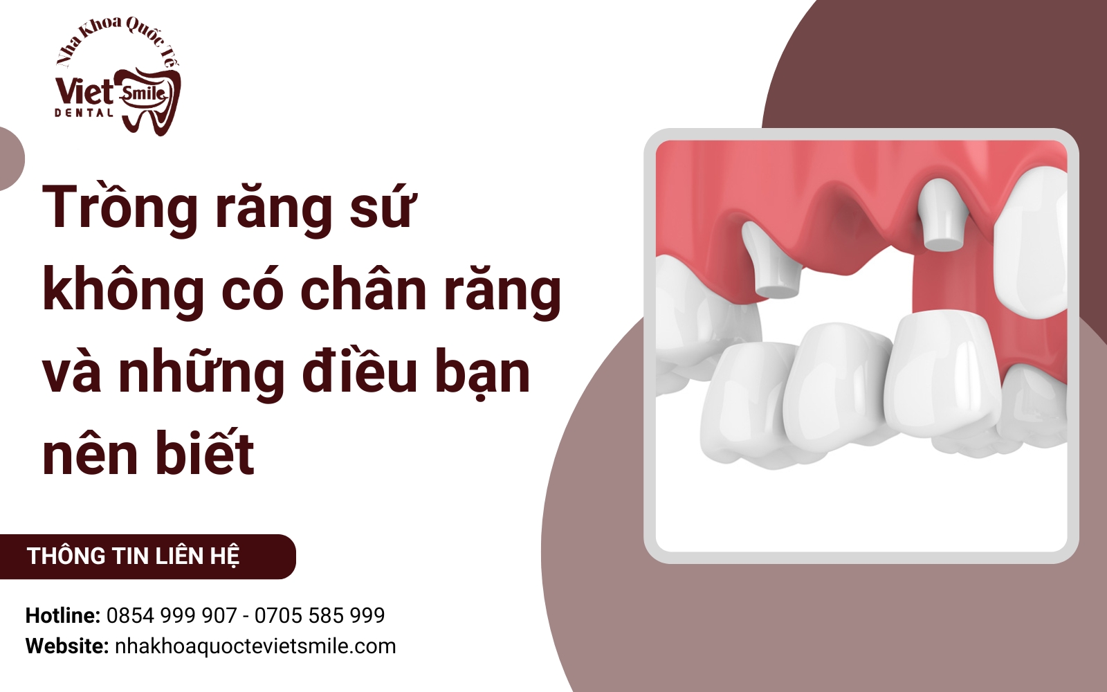 Trồng răng sứ không có chân răng và những điều bạn nên biết