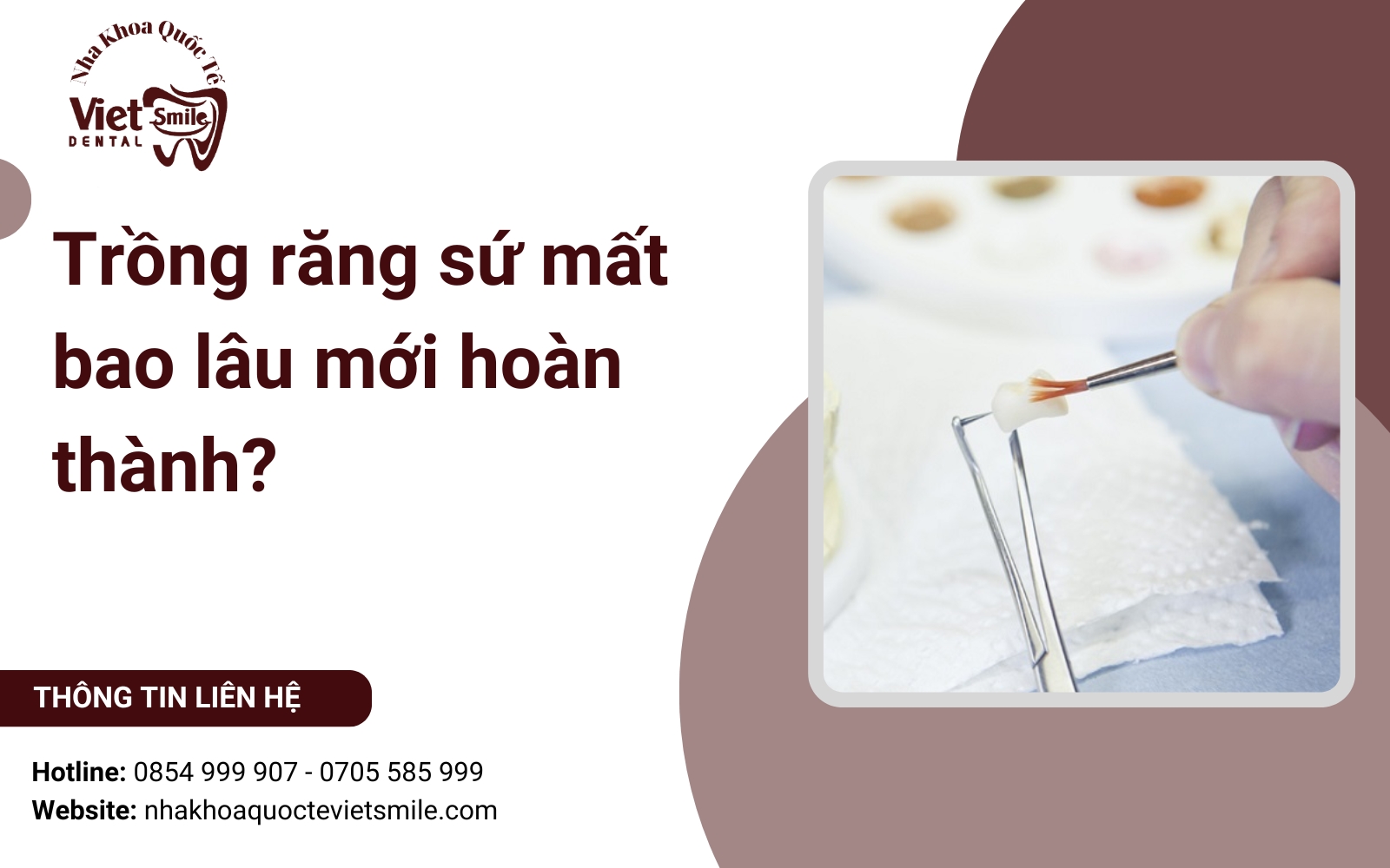 Trồng răng sứ mất bao lâu mới hoàn thành?