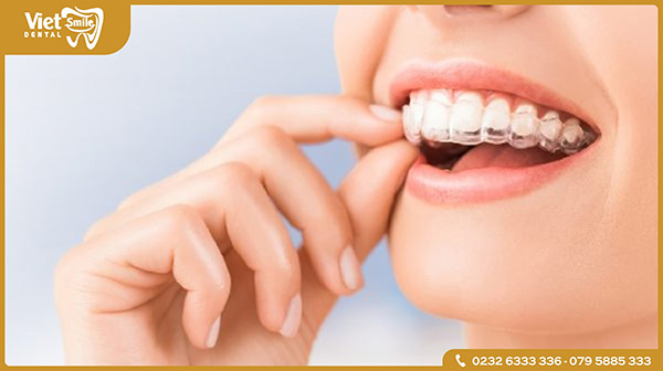 Niềng răng trong suốt Invisalign là gì? 