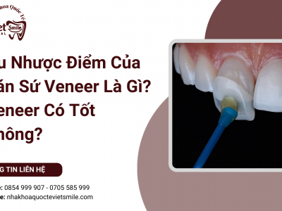 Ưu Nhược Điểm Của Dán Sứ Veneer Là Gì? Veneer Có Tốt Không? Ưu Nhược Điểm Của Dán Sứ Veneer Là Gì? Veneer Có Tốt Không?
