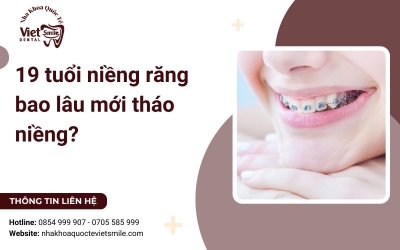 19 tuổi niềng răng bao lâu mới tháo niềng? 19 tuổi niềng răng bao lâu mới tháo niềng?
