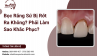 Bọc Răng Sứ Bị Rớt Ra Không? Phải Làm Sao Khắc Phục? Bọc Răng Sứ Bị Rớt Ra Không? Phải Làm Sao Khắc Phục?