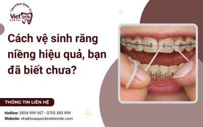 Cách vệ sinh răng niềng hiệu quả, bạn đã biết chưa? Cách vệ sinh răng niềng hiệu quả, bạn đã biết chưa?