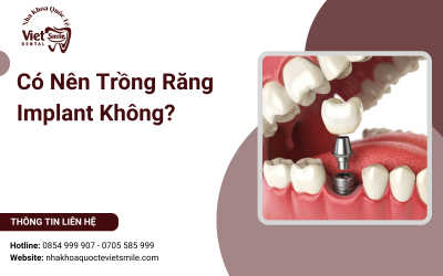 Có Nên Trồng Răng Implant Không? Có Nên Trồng Răng Implant Không?