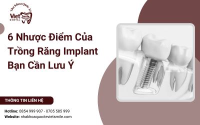 6 Nhược Điểm Của Trồng Răng Implant Bạn Cần Lưu Ý 6 Nhược Điểm Của Trồng Răng Implant Bạn Cần Lưu Ý