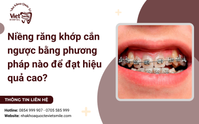 Niềng răng khớp cắn ngược bằng phương pháp nào để đạt hiệu quả cao? Niềng răng khớp cắn ngược bằng phương pháp nào để đạt hiệu quả cao?