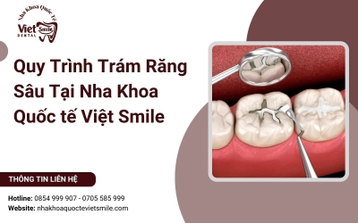 Quy Trình Trám Răng Sâu Tại Nha Khoa Quốc tế Việt Smile Quy Trình Trám Răng Sâu Tại Nha Khoa Quốc tế Việt Smile