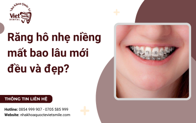 Răng hô nhẹ niềng mất bao lâu mới đều và đẹp? Răng hô nhẹ niềng mất bao lâu mới đều và đẹp?