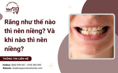Răng như thế nào thì nên niềng? Và khi nào thì nên niềng răng Răng như thế nào thì nên niềng? Và khi nào thì nên niềng răng