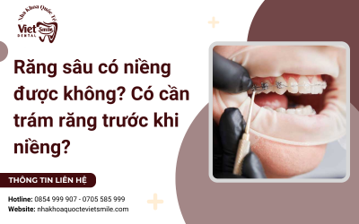 Răng sâu có niềng được không? Có cần trám răng trước khi niềng? Răng sâu có niềng được không? Có cần trám răng trước khi niềng?