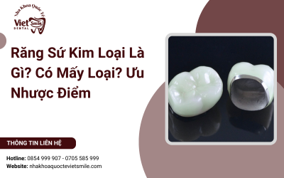 Răng Sứ Kim Loại Là Gì? Có Mấy Loại? Ưu Nhược Điểm Răng Sứ Kim Loại Là Gì? Có Mấy Loại? Ưu Nhược Điểm