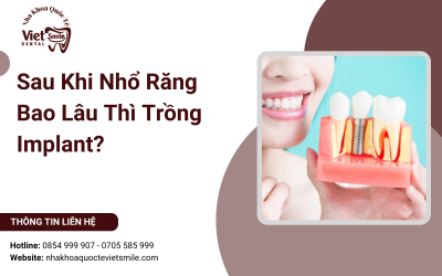 Sau Khi Nhổ Răng Bao Lâu Thì Trồng Implant? Sau Khi Nhổ Răng Bao Lâu Thì Trồng Implant?
