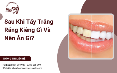Sau Khi Tẩy Trắng Răng Kiêng Gì Và Nên Ăn Gì? Sau Khi Tẩy Trắng Răng Kiêng Gì Và Nên Ăn Gì?
