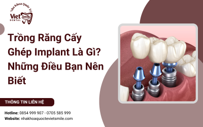 Trồng Răng Cấy Ghép Implant Là Gì? Những Điều Bạn Nên Biết Trồng Răng Cấy Ghép Implant Là Gì? Những Điều Bạn Nên Biết