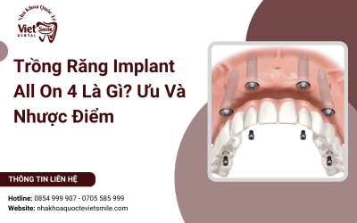 Trồng Răng Implant All On 4 Là Gì? Ưu Và Nhược Điểm Trồng Răng Implant All On 4 Là Gì? Ưu Và Nhược Điểm