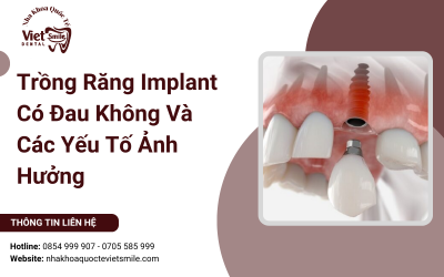 Trồng Răng Implant Có Đau Không? Các Yếu Tố Ảnh Hưởng Trồng Răng Implant Có Đau Không? Các Yếu Tố Ảnh Hưởng