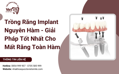 Trồng Răng Implant Nguyên Hàm - Giải Pháp Tốt Nhất Cho Mất Răng Toàn Hàm Trồng Răng Implant Nguyên Hàm - Giải Pháp Tốt Nhất Cho Mất Răng Toàn Hàm