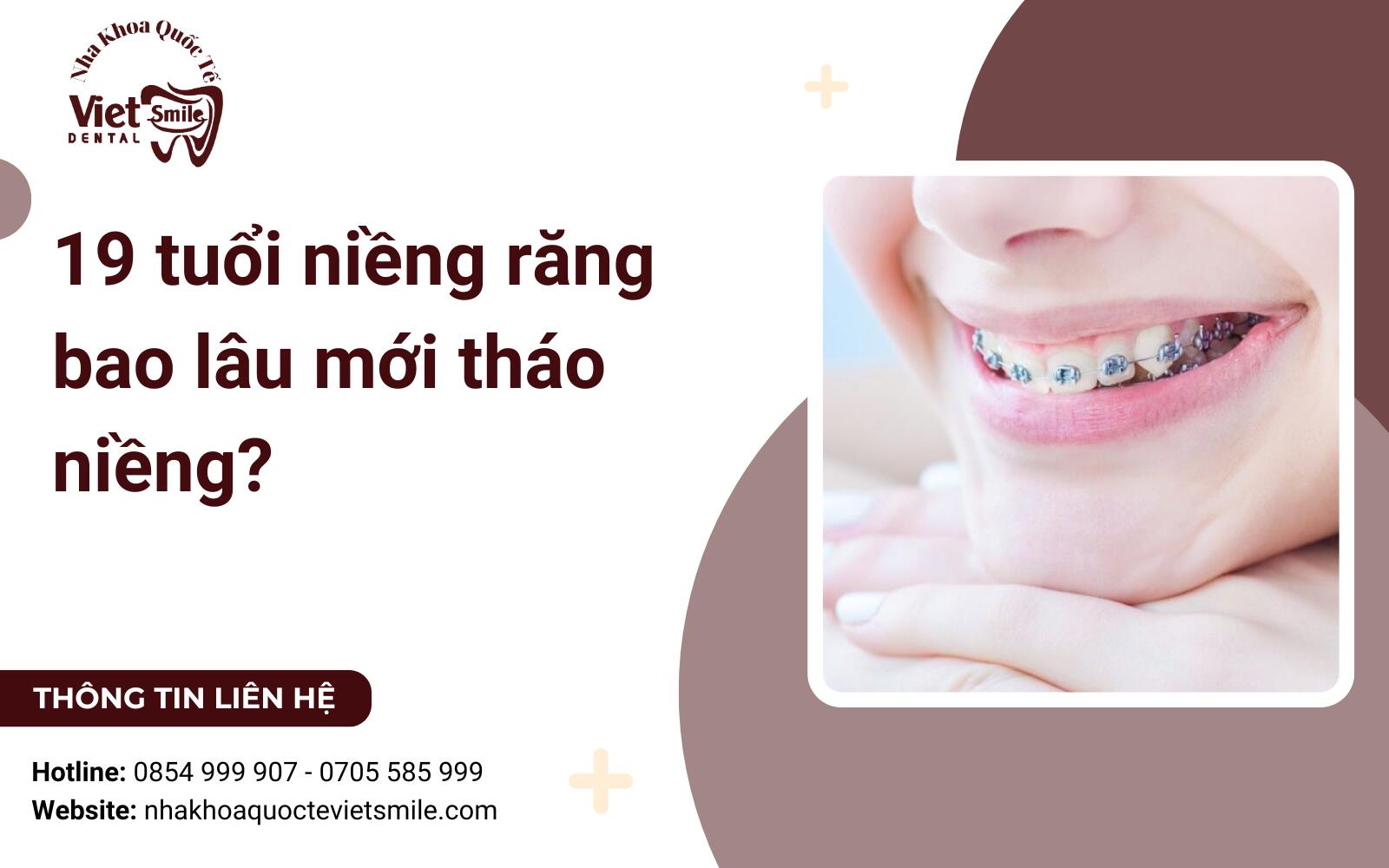 19 tuổi niềng răng bao lâu mới tháo niềng?