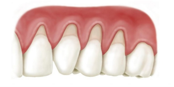 Bọc răng sứ bị tụt lợi do đâu? Cách xử trí và phòng tránh?