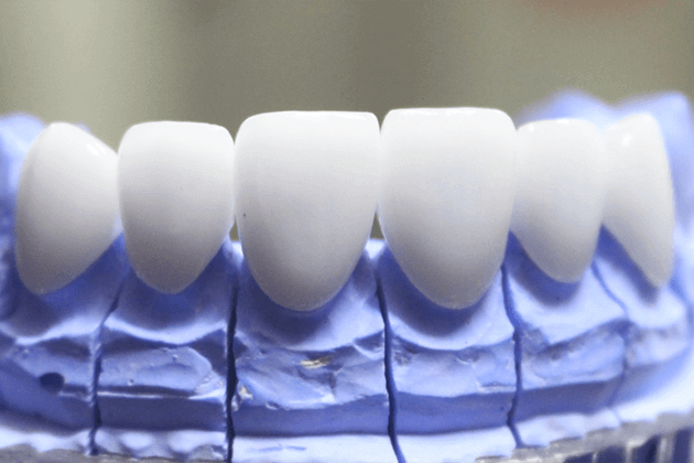 Răng sứ Ceramill Zolid giá bao nhiêu? Giá tại Nha khoa KIM là bao nhiêu?