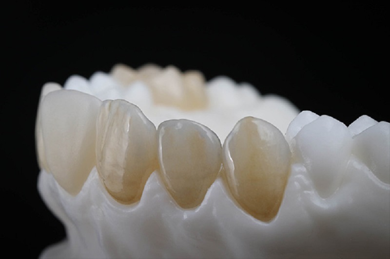 Răng sứ Venus - Nha Khoa Lavener Dental