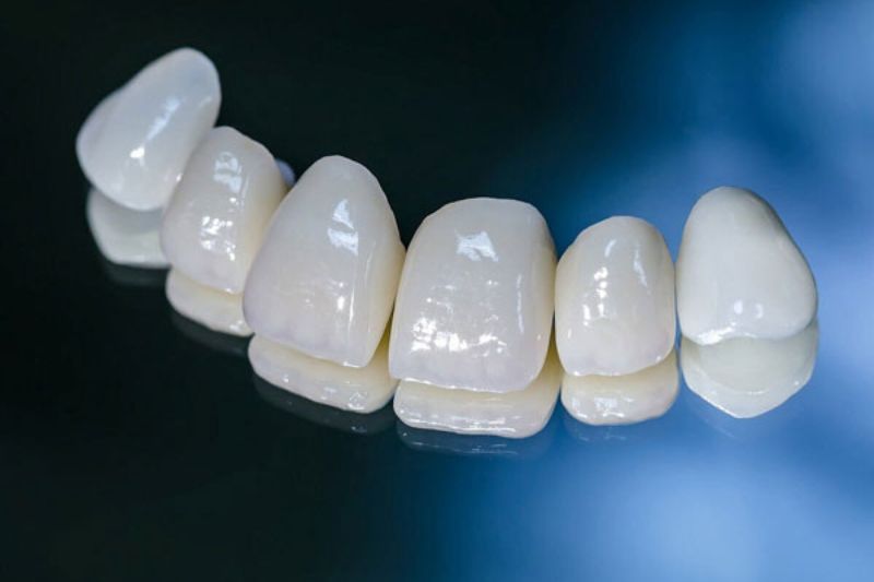 Răng sứ Lava có mấy loại? Bảng giá mới nhất 2025