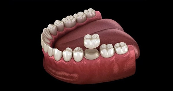 Bọc răng sứ 1 chiếc được không?