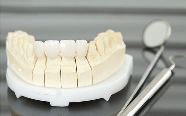 Tổng quan về kỹ thuật bọc răng sứ